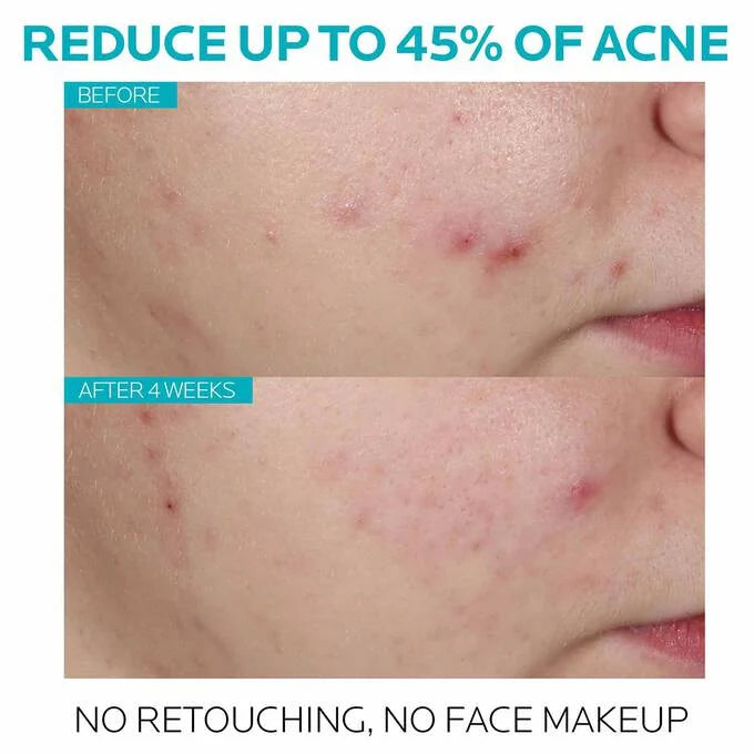 Suero para el tratamiento del acné con ácido salicílico Effaclar